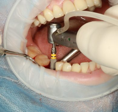 dental-implant